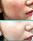 Miracle Truecica pad for reducing redness and acne scars